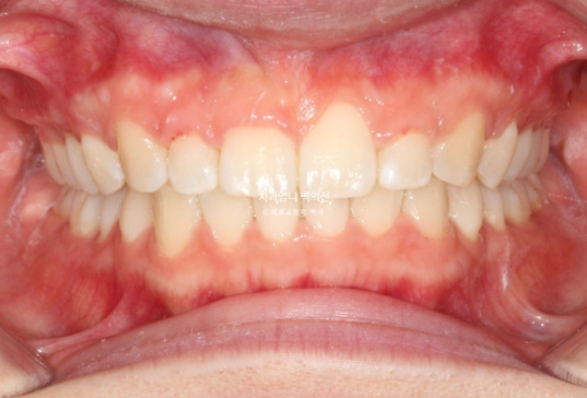 Inward-Tilted Teeth Orthodontic Treatment Review | Actual Case Improved with Non-Extraction Orthodontic Treatment for Gummy Smile, Deep Overbite & Gum Asymmetry — Gangnam Orthodontic Clinic image 8