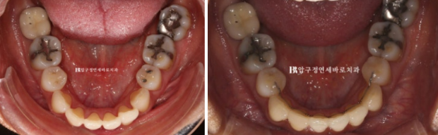 블랙트라이앵글 없애는 교정 가능할까요? 재교정 단기교정 후기 관련 이미지 11