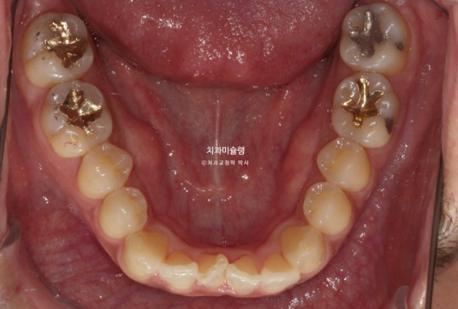 30대 MSE 악궁확장 덧니 반대교합 비발치 클리피씨 부작용 관련 이미지 4