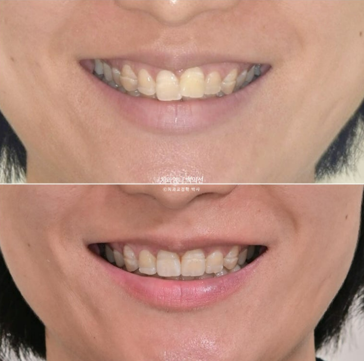 30대 교정 돌출입 교정 덧니 발치교정 치료기간 1년 8개월 관련 이미지 16