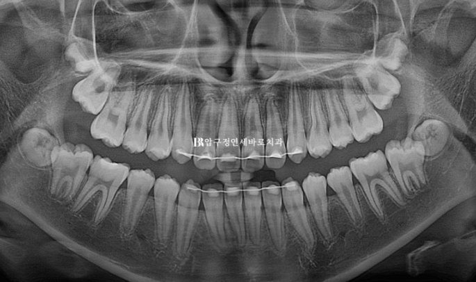 Simultaneous Arch Expansion and Teeth Alignment for Elementary School Children with Invisalign｜Invisalign First image 18