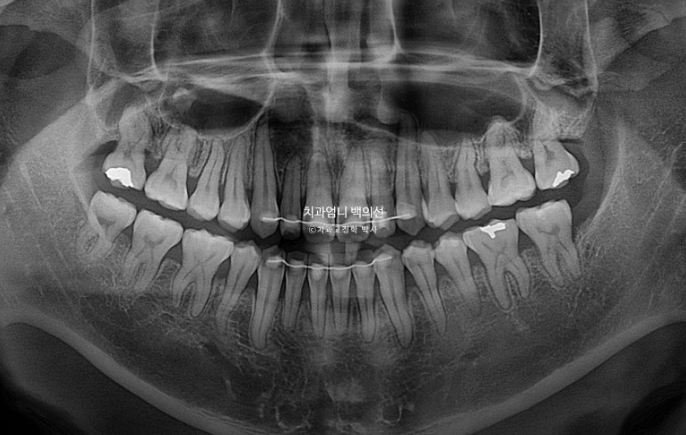 주걱턱 교정 반대교합 소구치 선천적 결손 부정교합 비발치 교정 후기 관련 이미지 16
