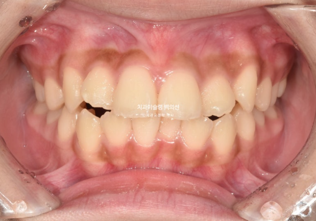 돌출입 무턱 인비절라인 발치교정 덧니 치료기간 1년 11개월 관련 이미지 2