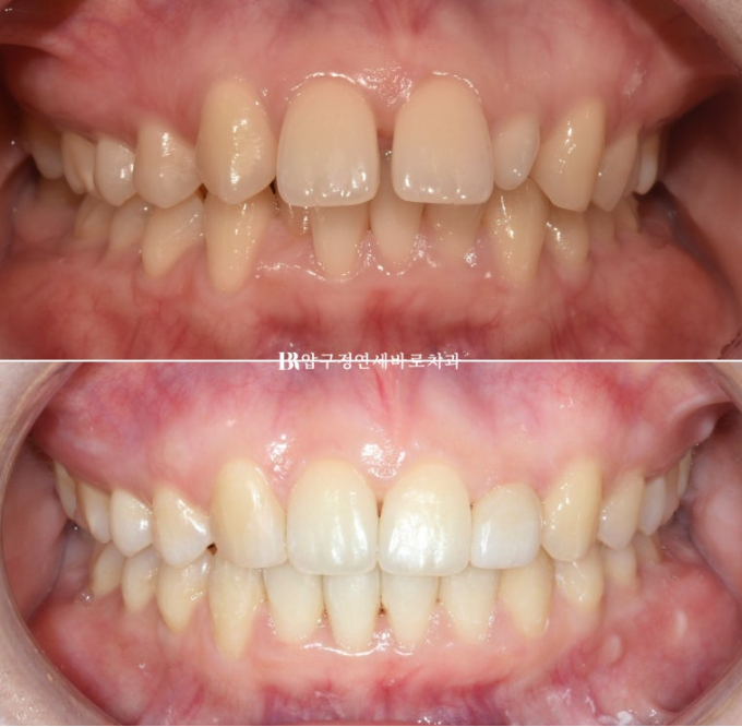 Actual Case of Treating Congenitally Missing and Peg-Shaped Teeth Without Implants image 1