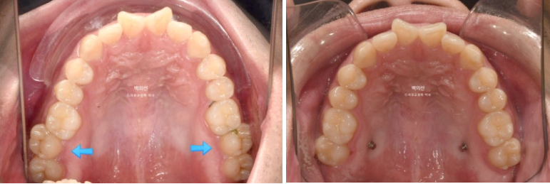 가위교합 나비치아 미니스크류 덧니 교정 인비절라인 라이트 관련 이미지 8