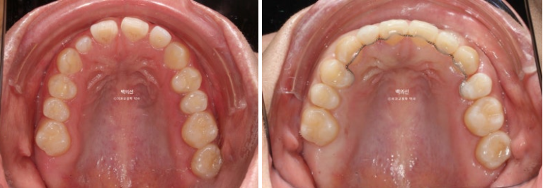 30대 치아교정 돌출입 교정 :: 잇몸미소 거미스마일 교정 입술부전증 결손치 무턱교정 관련 이미지 16