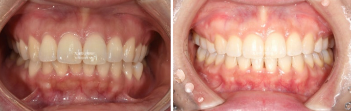 30대 돌출입 발치교정 입술부전증 치료 관련 이미지 11