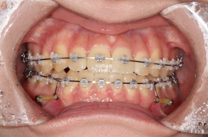 비발치 비수술 주걱턱 반대교합 재교정 치료 관련 이미지 6