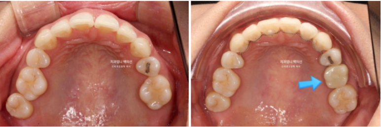 옥니 교정 역교정 재교정 무턱교정 치료기간 1년 10개월 관련 이미지 16