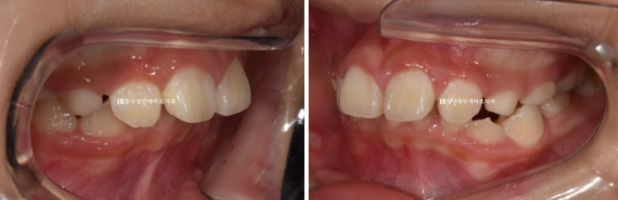 압구정 어린이교정 인비절라인 퍼스트 악궁확장 덧니 교정 관련 이미지 2