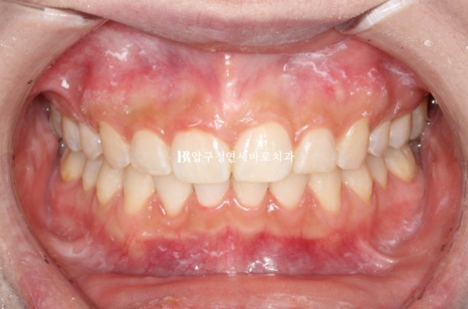 인비절라인 돌출입 발치교정 거미스마일 잇몸미소 교정 관련 이미지 9