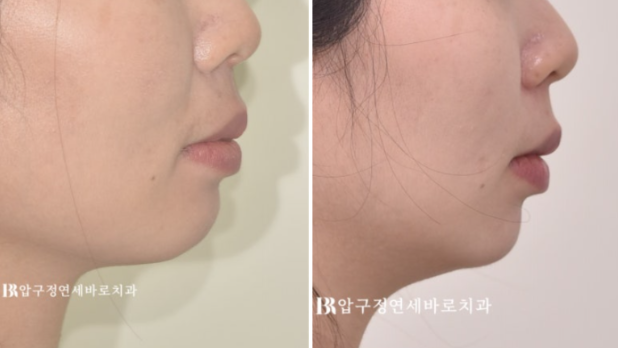 웃을 때 잇몸이 많이 보인다면? 거미스마일 원인과 교정 방법 관련 이미지 10