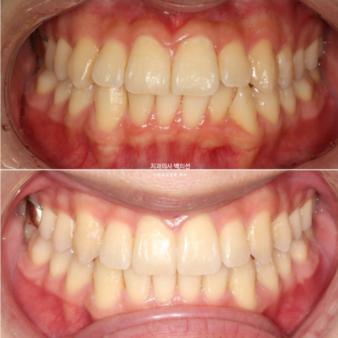 인비절라인 비발치 앞니 돌출 덧니 교정 ? 관련 이미지 1