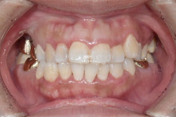 거미스마일 교정 돌출입 발치교정 입술부전 호두턱 치료기간 2년반 관련 이미지 2