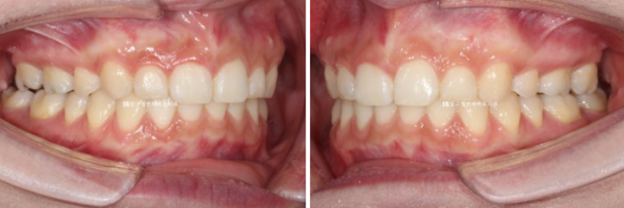 Does Invisalign Prevent Root Movement? Before-and-After Comparison of Extraction Treatment for Protruding Lips image 10
