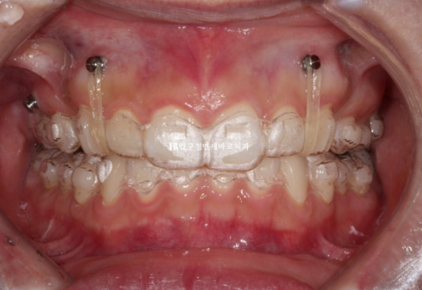 Can't Invisalign Move the Roots? An Actual Case of Extraction Treatment for Protruding Mouth at a Gangnam Orthodontic Clinic image 4