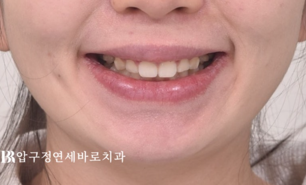 웃을 때 잇몸이 많이 보인다면? 거미스마일 원인과 교정 방법 관련 이미지 7