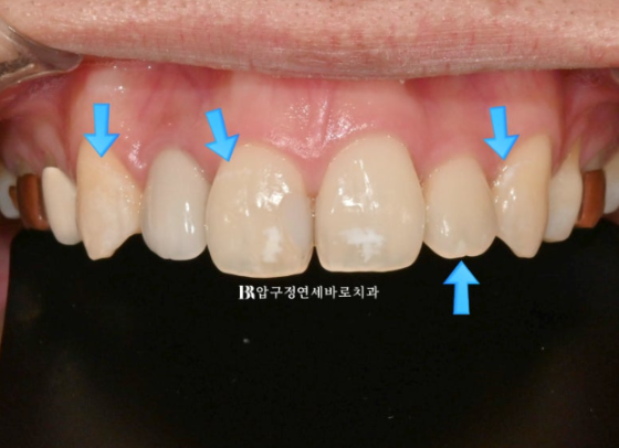 압구정 반점치 치료｜앞니 흰 반점(반상치) 앞니에 하얀얼룩? 관련 이미지 4