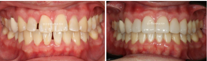 인비절라인 라이트 후 무삭제 라미네이트 치료 관련 이미지 2