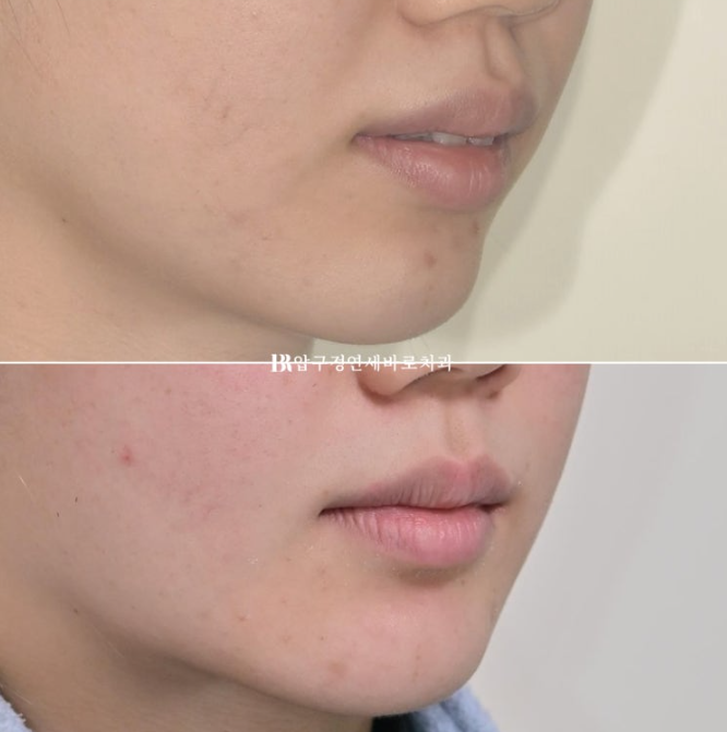 Gummy Smile Correction, Gummy Smile Orthodontics, Rabbit Teeth Correction image 16