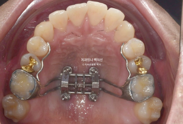 MSE Palatal Expansion Invisalign Underbite Correction, Non-Surgical image 4