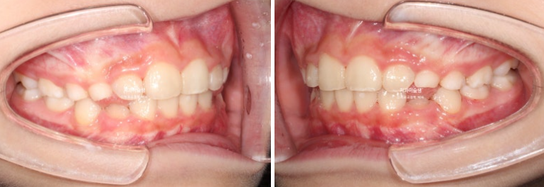 어린이 투명교정 인비절라인 퍼스트 과개교합 교정 후기 관련 이미지 15
