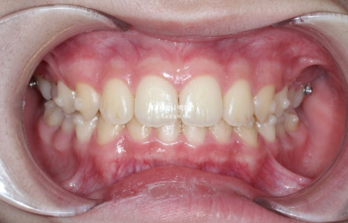 어린이 투명교정 인비절라인 퍼스트 가위교합 돌출교정 덧니교정 관련 이미지 5