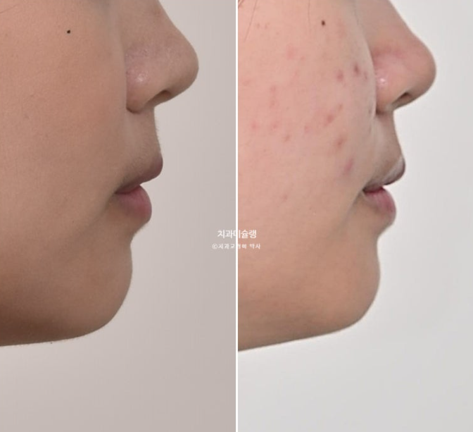 유학생 치아교정 해외거주 한국에서 치아교정? 관련 이미지 21