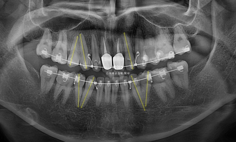 클리피씨 교정에서 인비절라인 변경 마무리 인비절라인 라이트 치료기간 4개월 관련 이미지 4