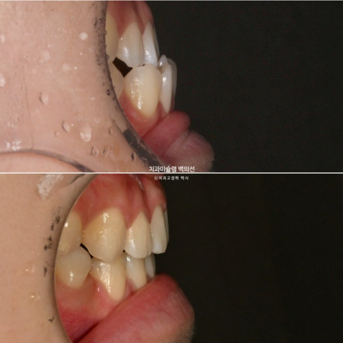 비수술 주걱턱 비대칭 발치 교정 결손치 반대교합 클리피씨 치료기간 1년 11개월 관련 이미지 15