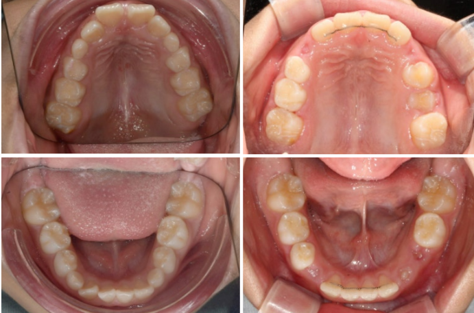 무턱교정 어린이 투명교정 인비절라인 퍼스트 교정 후기 관련 이미지 22