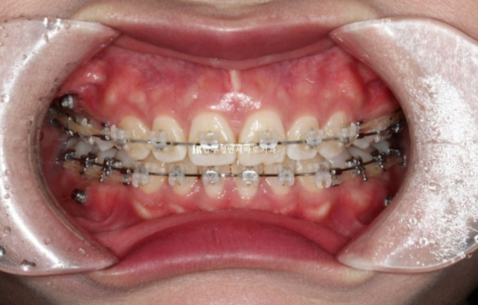 How Do the Buccal Corridors and Smile Line Change After Extraction Treatment for Protruding Teeth?|An Orthodontic Case That Also Improved Lip Incompetence image 7