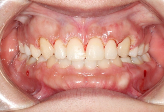 30대 치아교정 돌출입 교정 :: 잇몸미소 거미스마일 교정 입술부전증 결손치 무턱교정 관련 이미지 11
