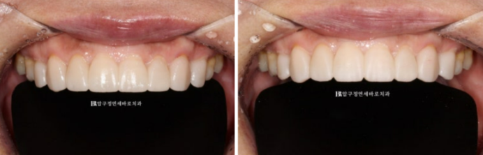 50대 라미네이트 삭제 없이 하는 법? 관련 이미지 9