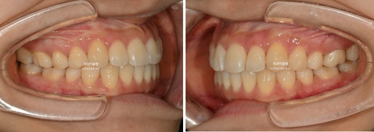 인비절라인 라이트 반대교합? 덧니 중심선 치간삭제 치료 관련 이미지 12