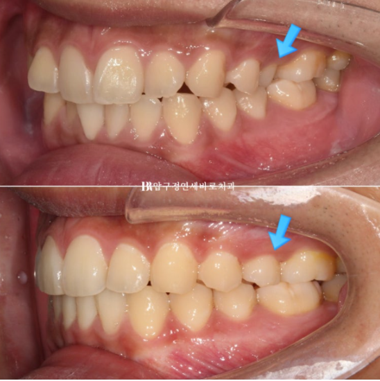 인비절라인 라이트 교정 덧니 이소맹출 반대교합 관련 이미지 12