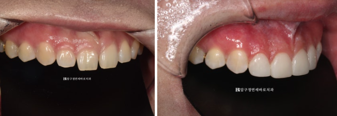 Four No-Prep Veneers for Dwarf Teeth and Conical Front Teeth image 8