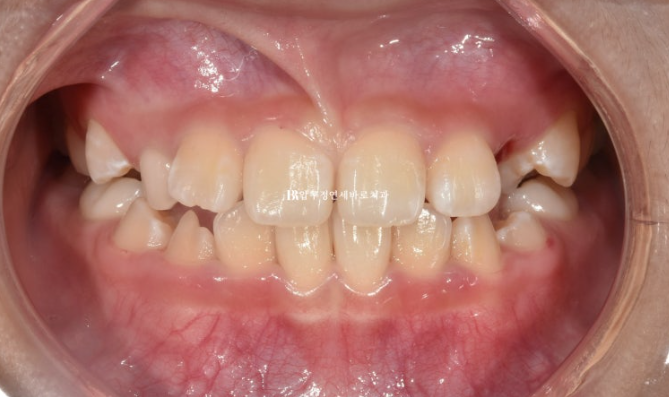 Simultaneous Arch Expansion and Teeth Alignment for Elementary School Children with Invisalign｜Invisalign First image 2