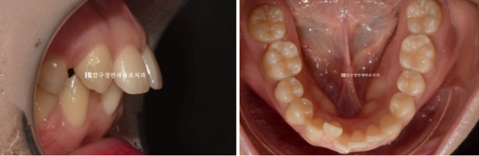 Actual Case of Treating Congenitally Missing and Peg-Shaped Teeth Without Implants image 6