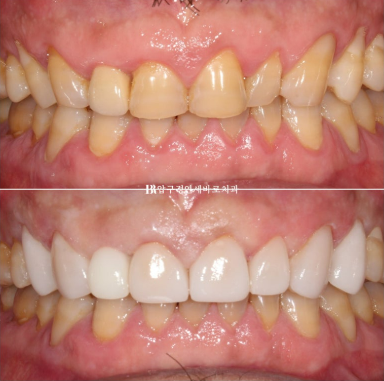 50대 중년교정 무삭제 라미네이트 중년 부분교정 후기 관련 이미지 9