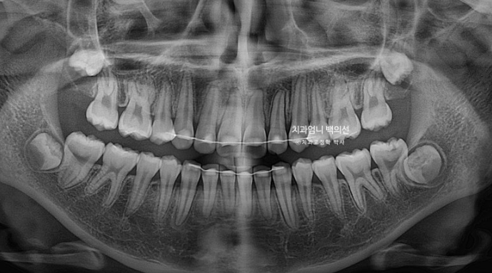 입이 안 다물어짐 입술부전증 호두턱 교정? 관련 이미지 15