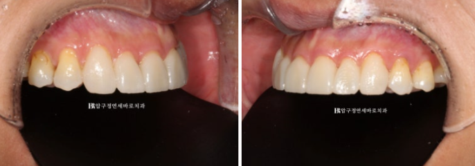 How to Avoid Regretting No-Prep Laminate Veneers: The Fitting Process Revealed image 4