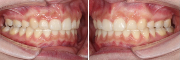 Can't Invisalign Move the Roots? An Actual Case of Extraction Treatment for Protruding Mouth at a Gangnam Orthodontic Clinic image 10