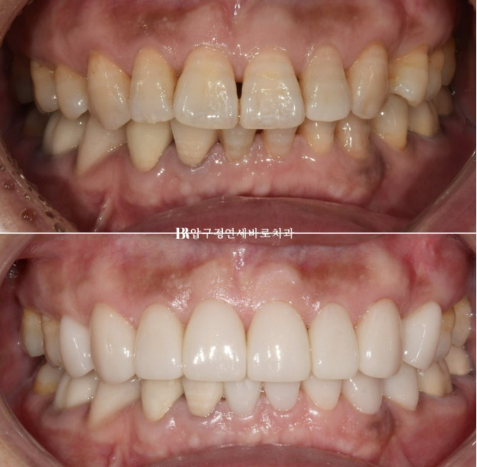 50대 라미네이트 삭제 없이 하는 법? 관련 이미지 10