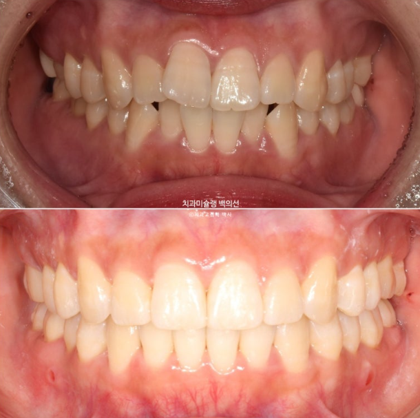인비절라인 돌출입 발치교정 임플란트 없이 사랑니 대체 관련 이미지 22