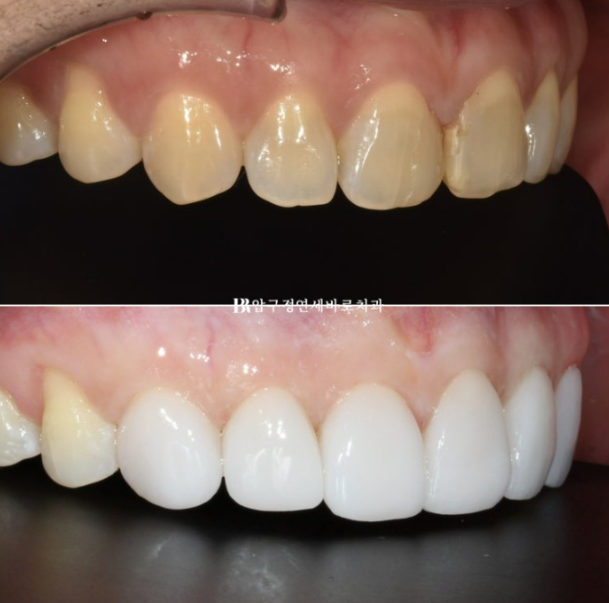 Can Gaps Between the Front Teeth Be Treated with No-Prep Veneers Alone? A Real Case Completed with Gelami After Invisalign Lite image 23