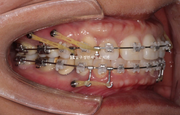 40대 재교정 가능할까요? 비발치 돌출입 교정 호두턱 팔자주름 후기 관련 이미지 4