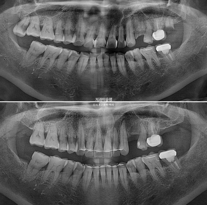 50대 치아교정 돌출 치아벌어짐 중년교정 관련 이미지 22