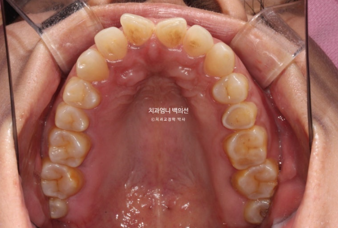 40대 인비절라인 라이트 앞니 벌어짐 뻗침 돌출 치료 관련 이미지 5