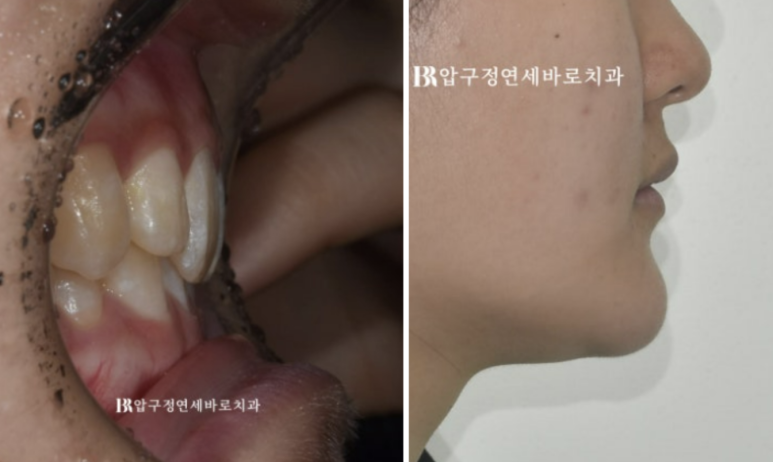 옥니교정 / 웃을때 아랫니만 보여요. 앞니 노출도 교정? 관련 이미지 2